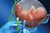 بررسی ژنتیکی بیماران مبتلا به MPS برای جلوگیری از تولد فرزندان معلول