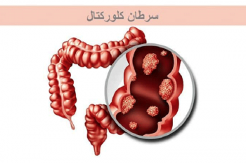 اجرای طرح بررسی عوامل خطر و خصوصیات سرطان روده در جهاددانشگاهی فارس