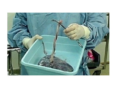 دستیابی به دانش فنی سلولهاي بنيادين بند ناف