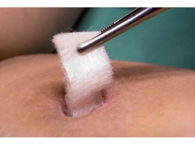 طراحی و ساخت زخم پوش پیشرفته بر پایه پلیمرهای طبیعی