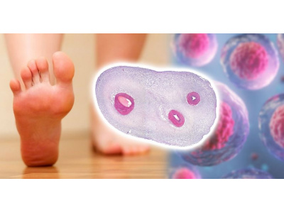 بررسی ایمنی و اثربخشی استفاده از سلولهای بنیادی مزانشیمی آلوژنیک در درمان زخم مزمن پای دیابتی نوروپاتیک