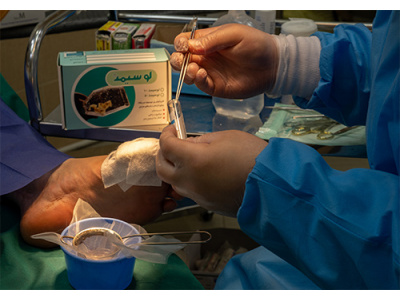 درمان زخمهای دیابتی