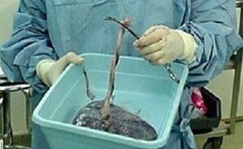 دستیابی به دانش فنی سلول‌هاي بنيادين بند ناف