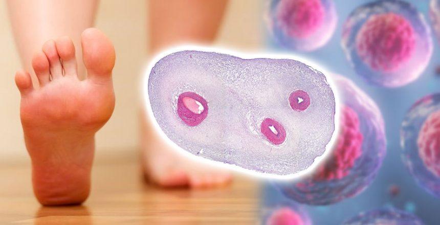 بررسی ایمنی و اثربخشی استفاده از سلولهای بنیادی مزانشیمی آلوژنیک در درمان زخم مزمن پای دیابتی نوروپاتیک