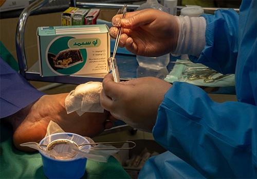 درمان زخمهای دیابتی